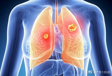 肺癌篩查為什麼不用高劑量ct（肺癌篩查千萬記住用CT）1