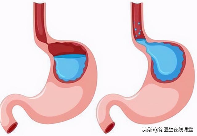 膽汁反流與胃食管反流的差别（膽汁反流與胃食管反流有何不同）2