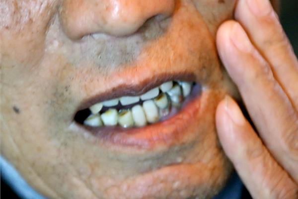 牙周炎引起的牙活動了自己能掉嗎（牙周炎一般有哪些表現）2