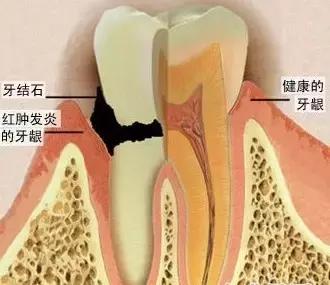 為什麼吃華素口腔潰瘍牙疼（Helen齒科中心刷牙經常出血是怎麼回事）3