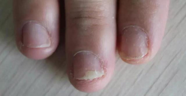 科普指甲型銀屑病與灰指甲的區别（指甲型銀屑病與灰指甲的區别）1