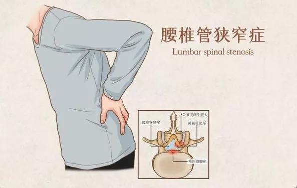 腰椎管狹窄隻有手術才能根治嗎（腰椎管狹窄怎麼辦）1
