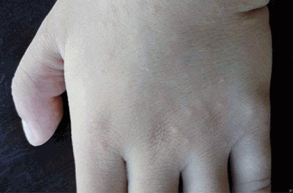 手指頭有水泡癢癢是腳氣嗎（手腳癢癢的還起小水疱）3
