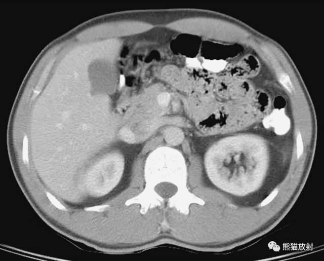 肝總管ct解剖位置（收藏上腹部CT斷層）27