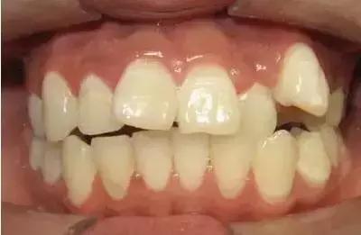 遺傳性牙颌畸形的主要表現方式（孩子的這20種牙颌畸形問題需要在12歲前解決）2