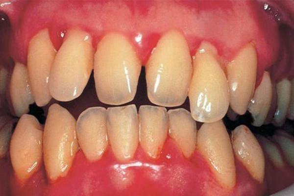 牙龈腫了出血會自愈嗎（牙龈腫脹怎麼辦）2