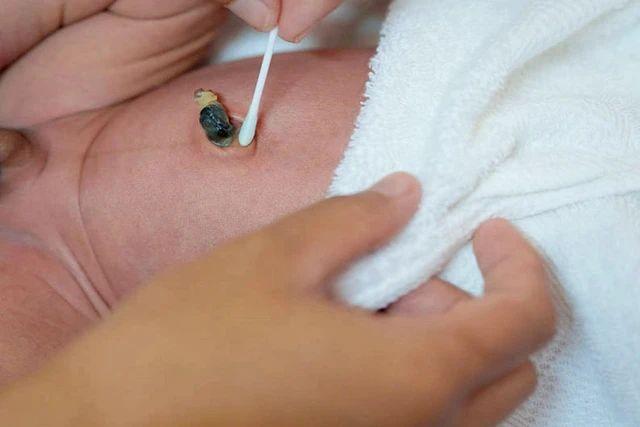 新生兒臍帶的護理及異常情況處理（關于新生寶寶臍帶護理那些事）6