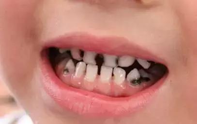 遺傳性牙颌畸形的主要表現方式（孩子的這20種牙颌畸形問題需要在12歲前解決）10
