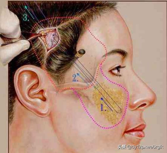 小切口除皺面部提升能維持多久（小切口除皺術能改善哪些面部問題）6