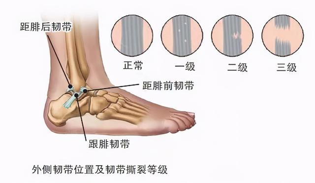 踝關節扭傷外踝凸起診斷（踝關節扭傷診療指南）3