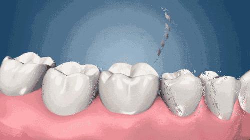 全口即刻種植牙的詳細步驟（即刻負重的種植牙）(3)