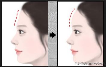 小切口除皺面部提升能維持多久（小切口除皺術能改善哪些面部問題）5