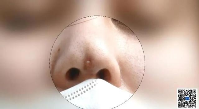 假體鼻子有膿包怎麼辦（假體穿出傷口流膿）6
