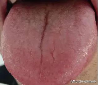 舌頭裂紋是什麼造成的怎麼恢複（舌頭有很多裂紋怎麼辦）1