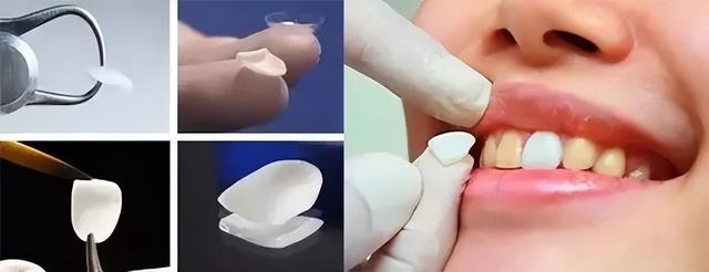 比較好用的修複牙齒的方法（一項修複牙齒的技術）4