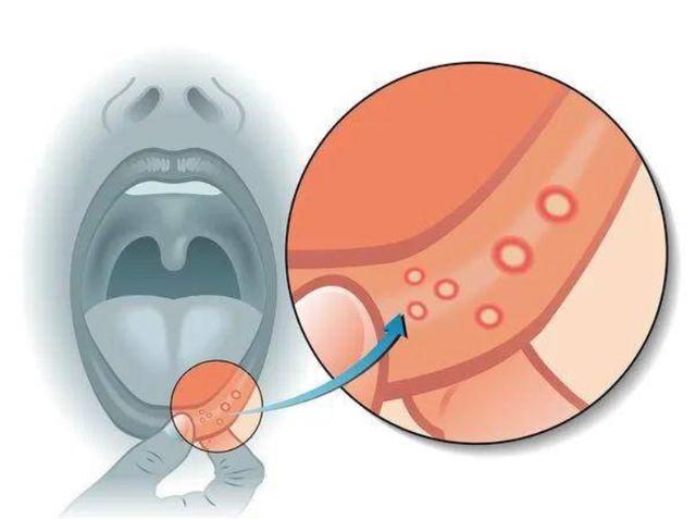口腔癌早期的2個表現（早期信号有哪些）1