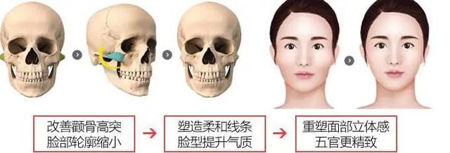 高顴骨五官集中的臉型怎麼辦（面部凹陷還是顴骨突出）3