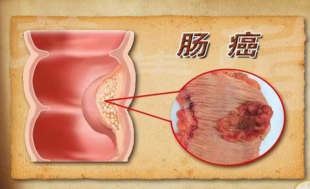 直腸癌的6個早期症狀做什麼檢查（直腸癌多半是拖出來）(2)