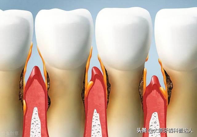 牙龈上火出血是缺什麼維生素（上火or缺乏維生素）3