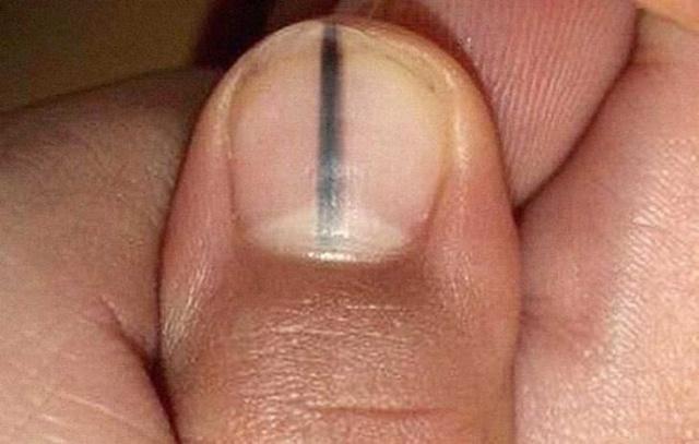 指甲上的月牙就一定代表健康嗎（指甲上的白點豎紋）6