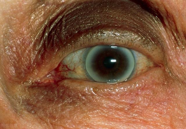導緻眼睛疾病的五個因素（健康問題眼睛有預兆）5