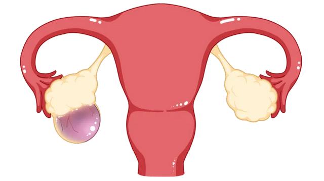 卵巢囊腫用什麼方法能治愈（同樣是卵巢囊腫）1