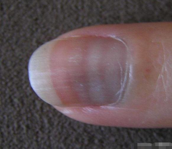 指甲上的月牙就一定代表健康嗎（指甲上的白點豎紋）3
