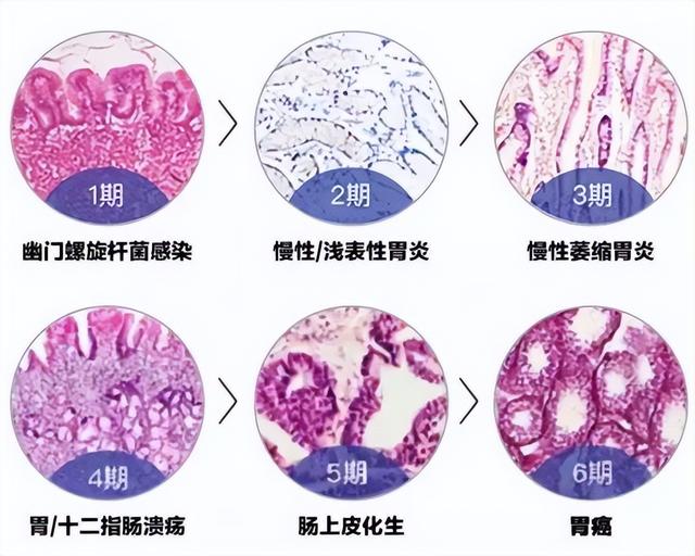 幽門螺旋杆菌的三大檢測方法（幽門螺旋杆菌檢測知多少）3
