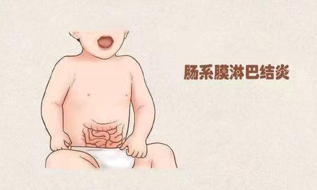 腸系膜淋巴結炎的發病年齡（急性腸系膜淋巴結炎多見于7歲以下）1
