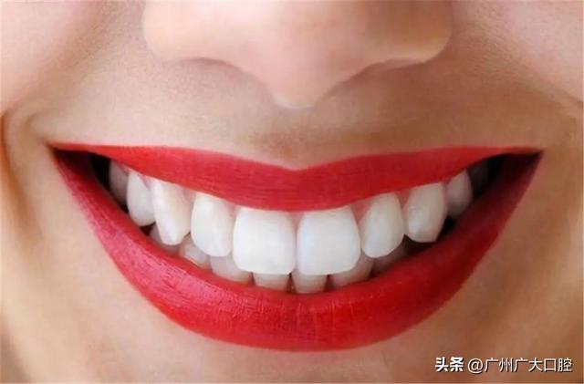 牙齒美白方法的優缺點（牙齒美白有多少種方式）1