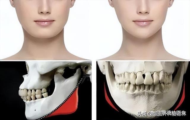 正颌手術能矯正面部不對稱嗎（小夥子大小臉嚴重偏颌）1