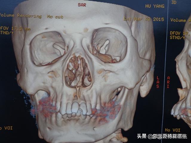 正颌手術能矯正面部不對稱嗎（小夥子大小臉嚴重偏颌）5