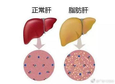 脂肪肝什麼情況會癌變（輕度脂肪肝也可能會癌變）1
