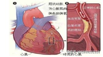 急性心梗的各種前兆（急性心梗的識别與處理）2